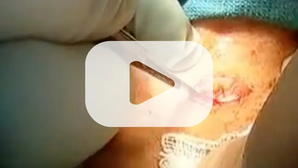 Minimally Invasive Video-Assisted Thyroid Surgery
