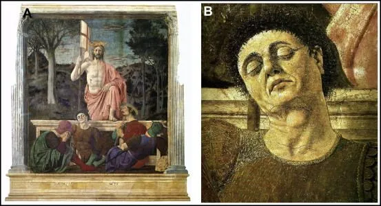 Thyroid swellings in Italian Renaissance art