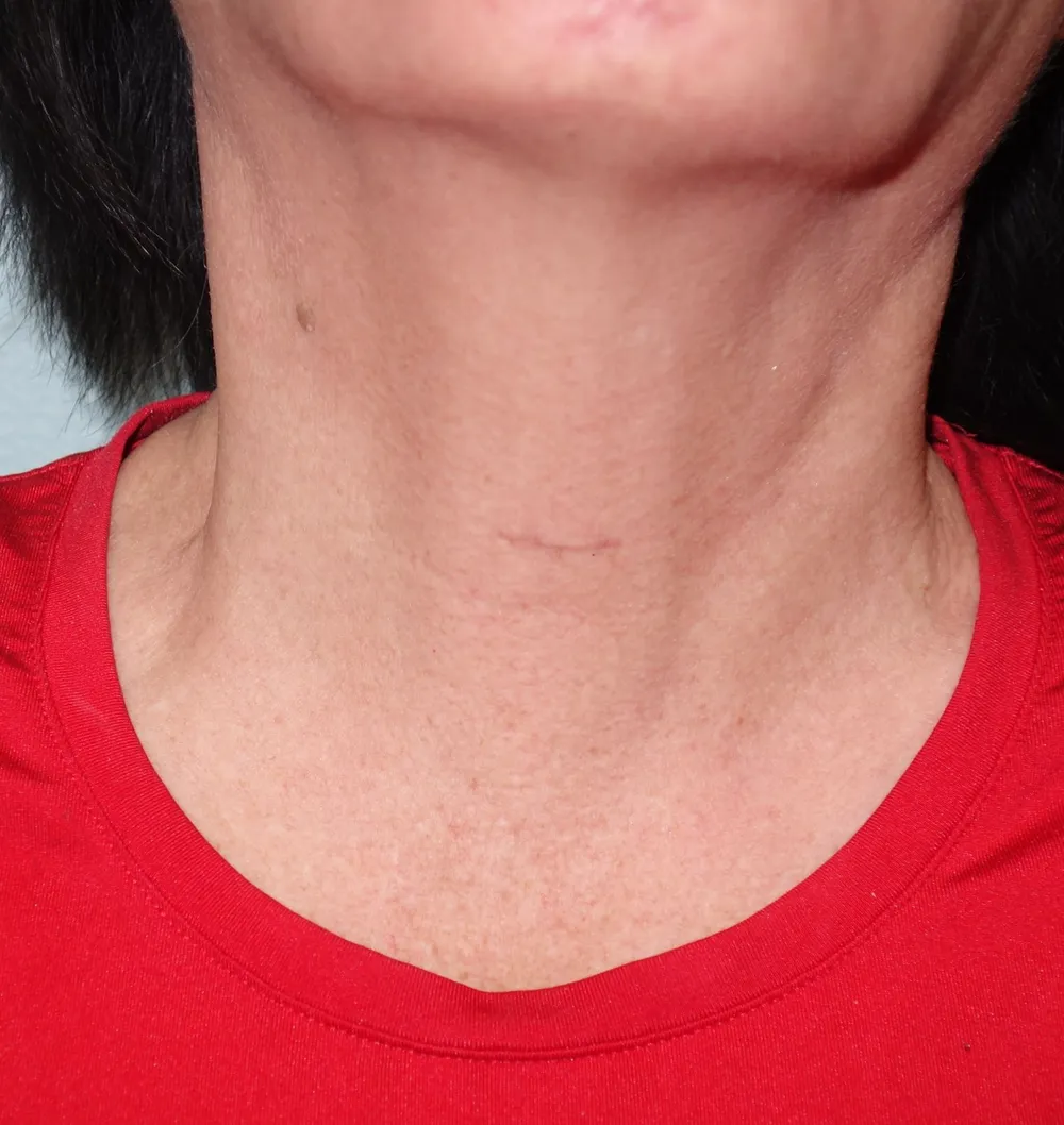 Minimally invasive thyroid surgery result — small neck incision