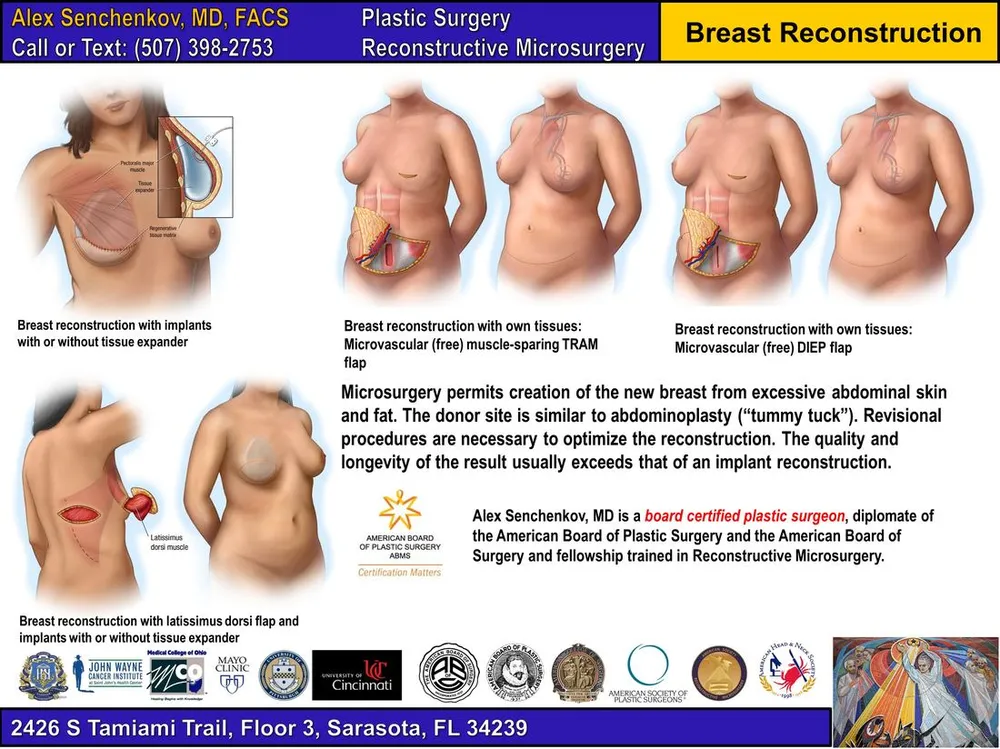 Breast reconstruction techniques: implants, TRAM flap, DIEP flap, latissimus dorsi flap